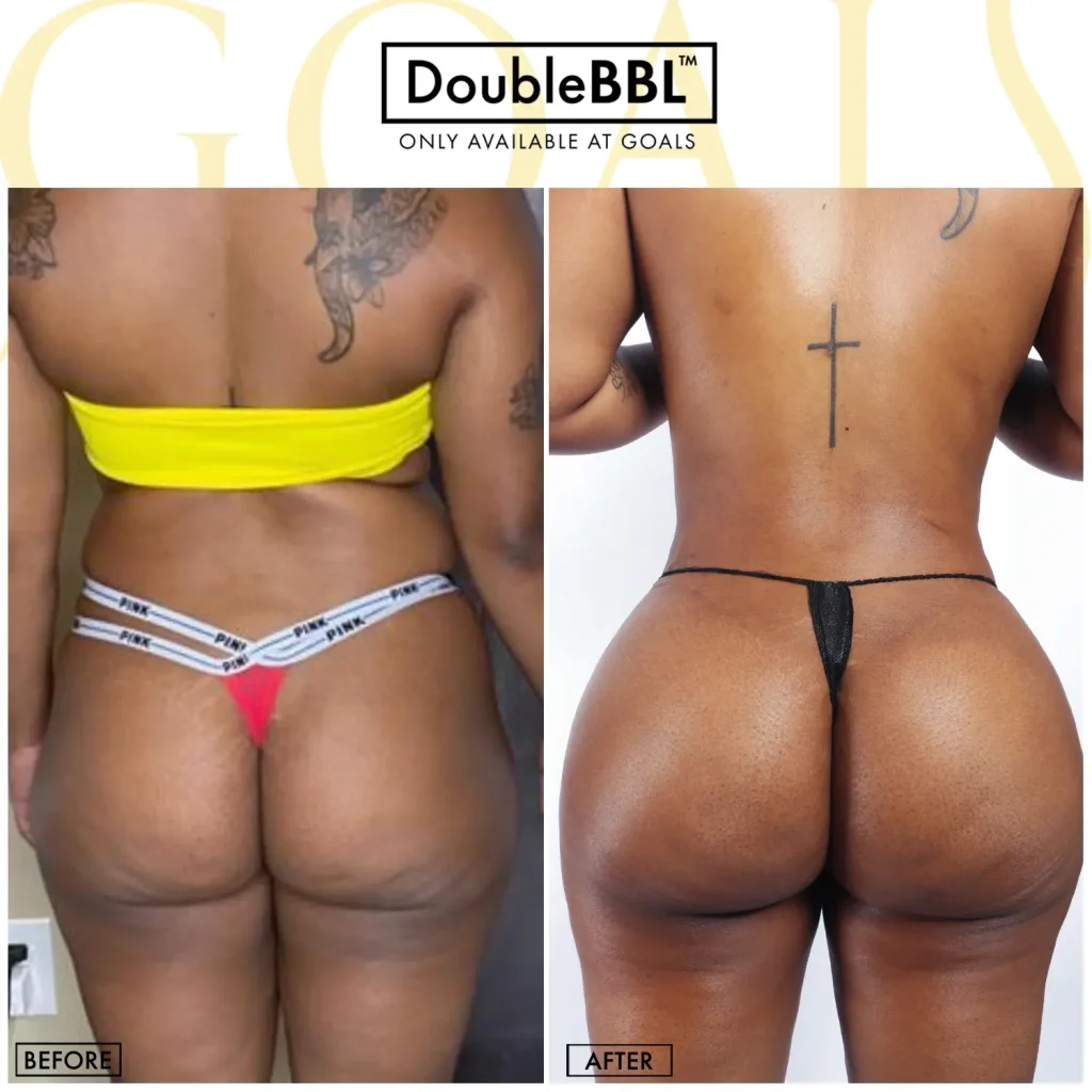 Before and after — Brazilian Butt Lift, patient 4