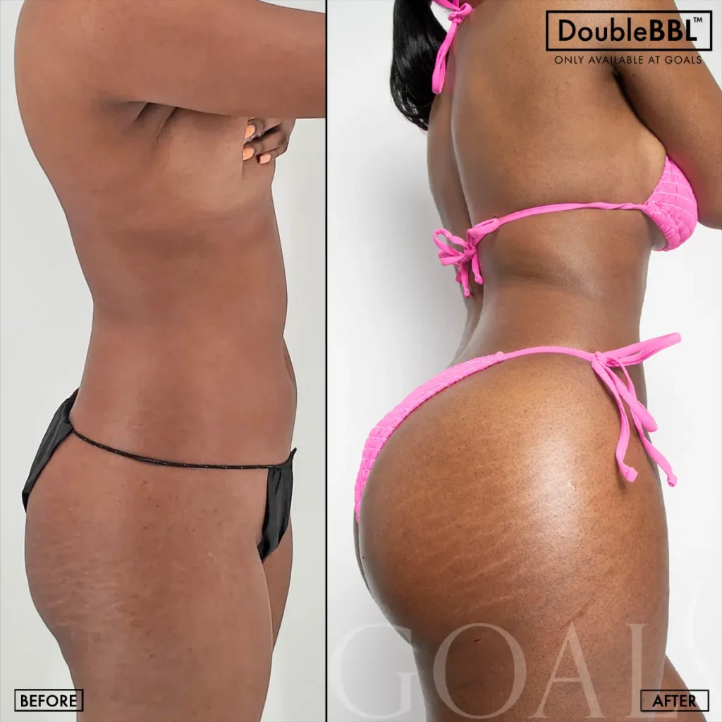 Before and after — Brazilian Butt Lift, patient 5