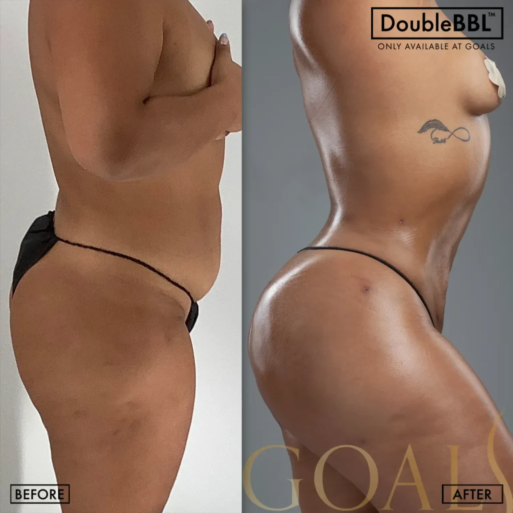 Before and after — Brazilian Butt Lift, patient 6