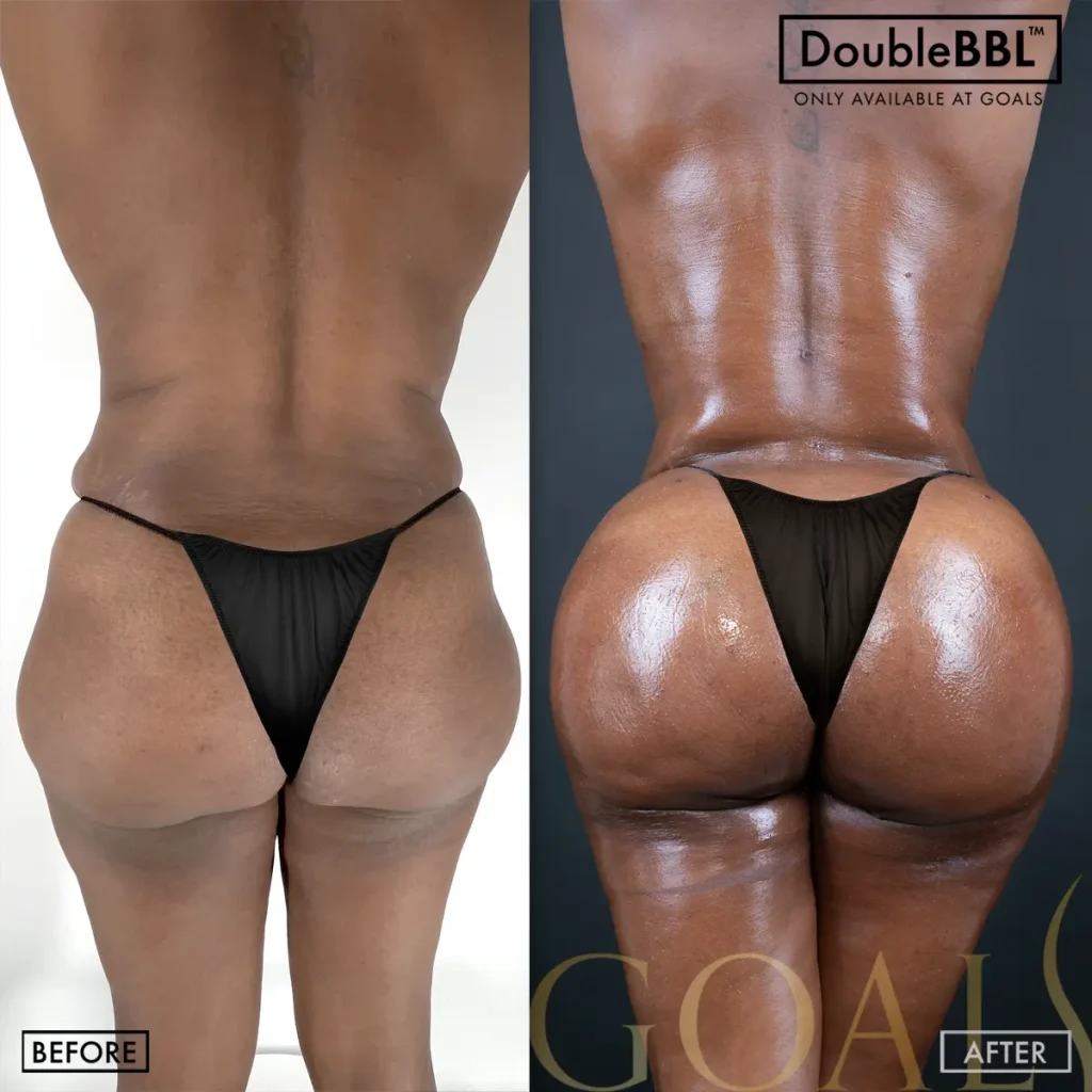 Before and after — Brazilian Butt Lift · Philadelphia, patient 1