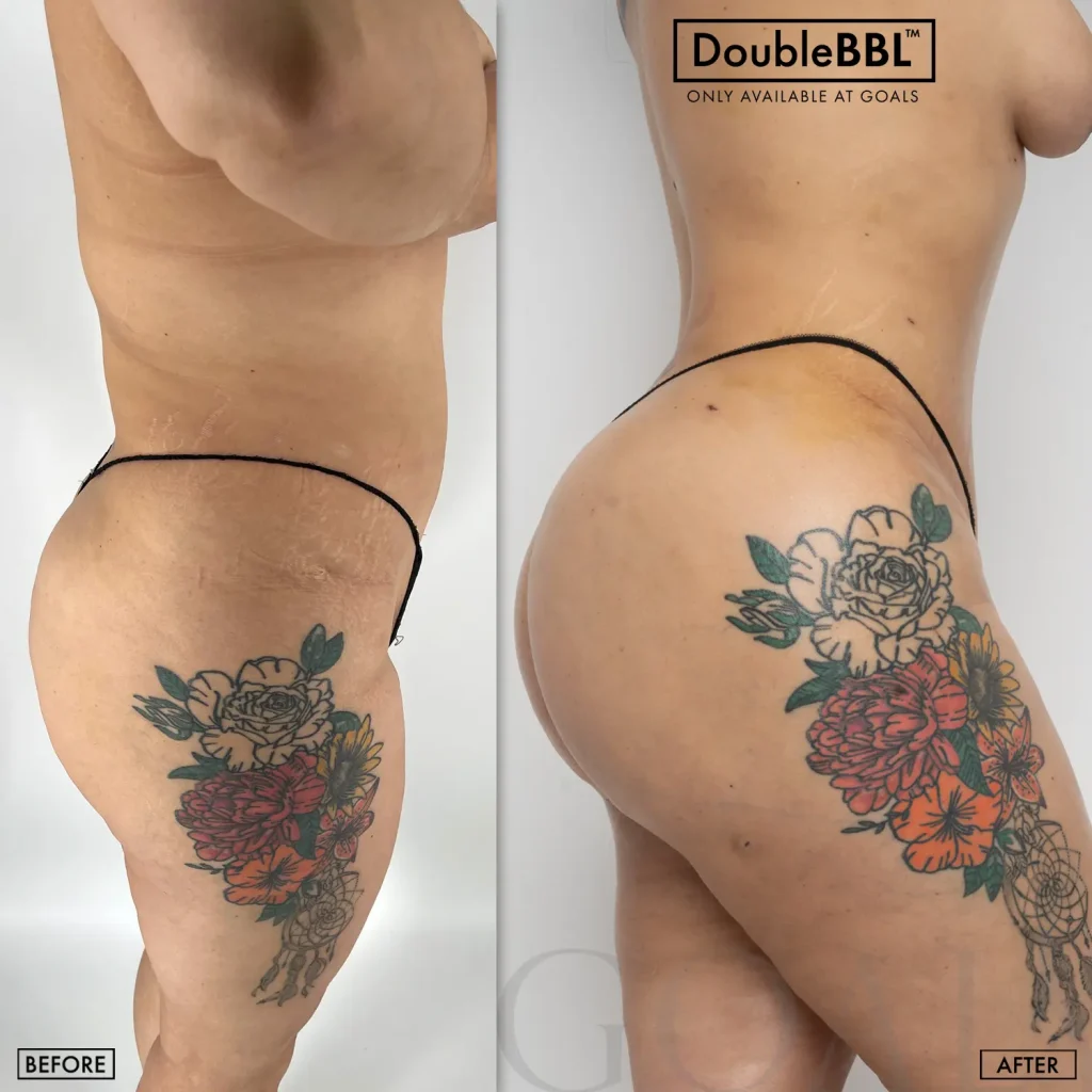 Before and after — Brazilian Butt Lift · Philadelphia, patient 2