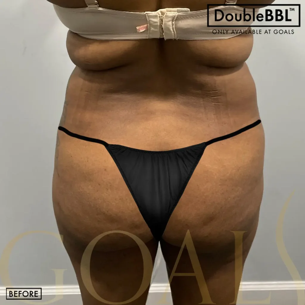 Before and after — Brazilian Butt Lift · Philadelphia, patient 3