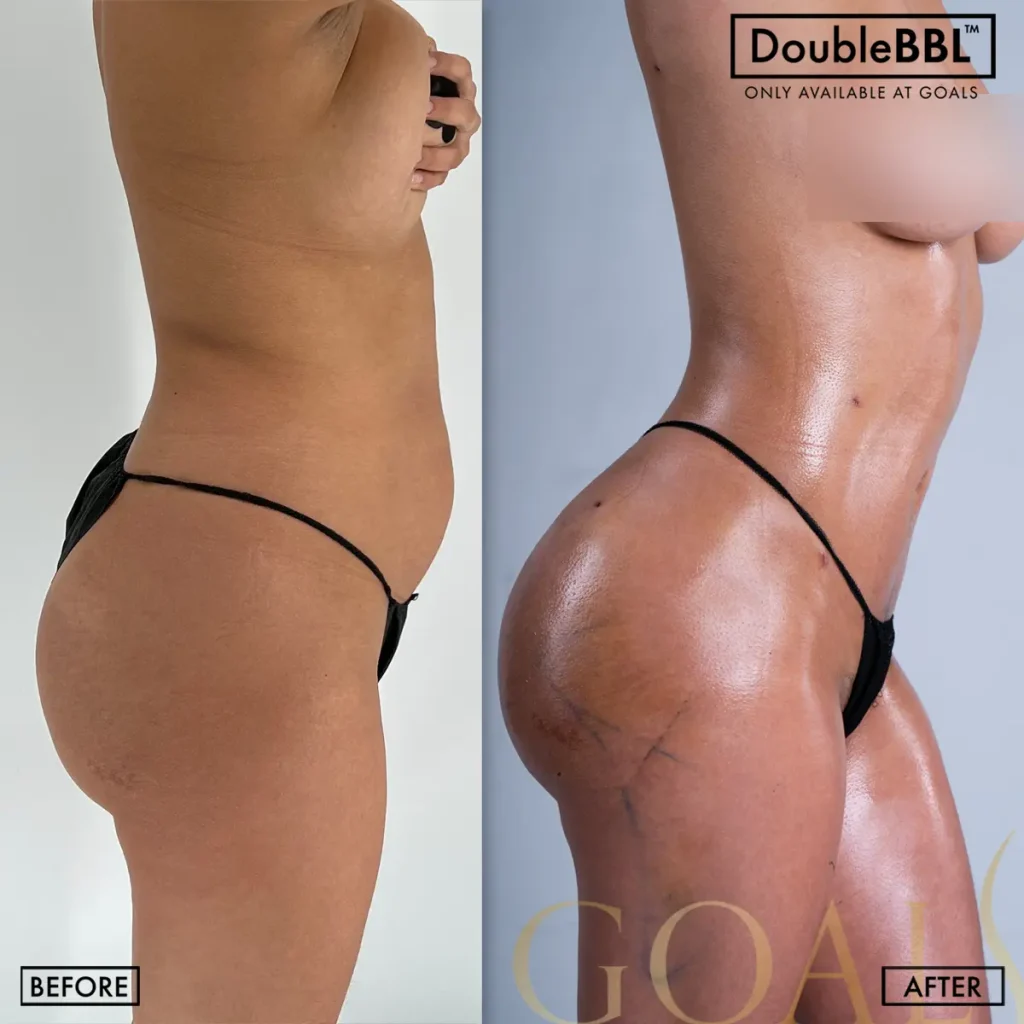 Before and after — Brazilian Butt Lift · Philadelphia, patient 4