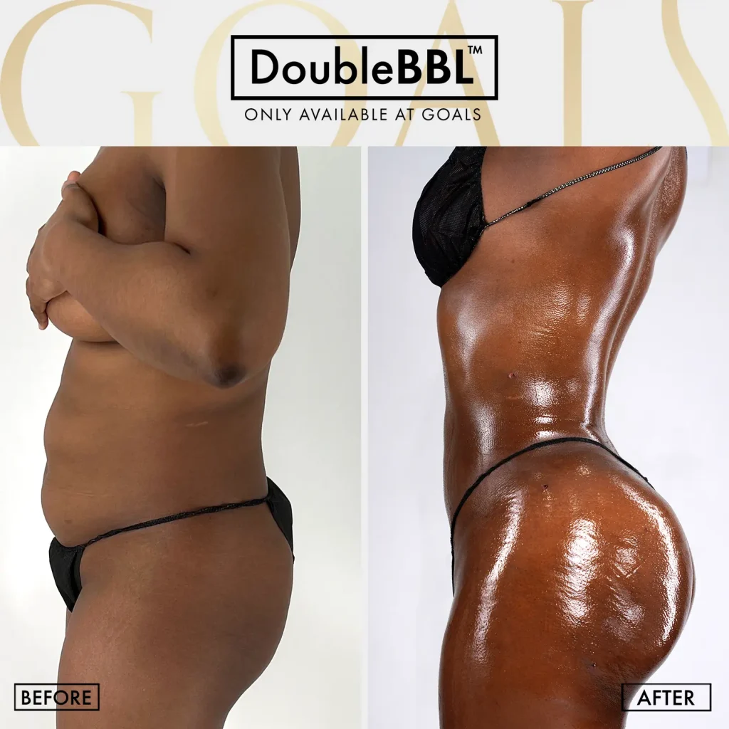 Brazilian Butt Lift — patient result