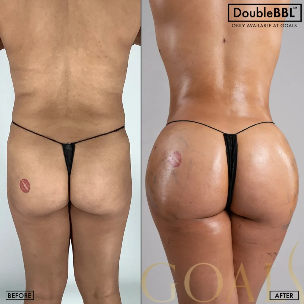 Brazilian Butt Lift — patient result