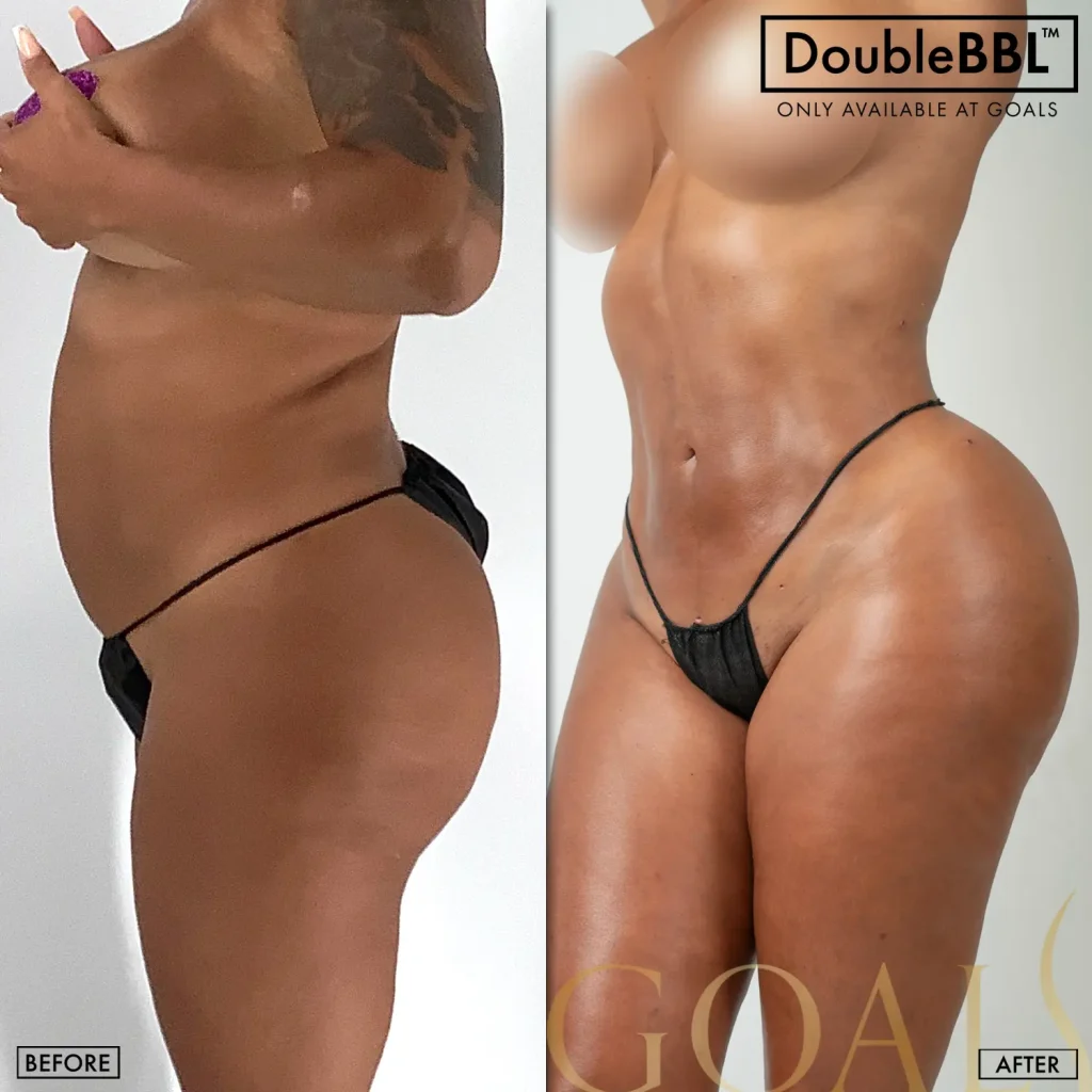 Before and after — Brazilian Butt Lift · Ridgefield, patient 3