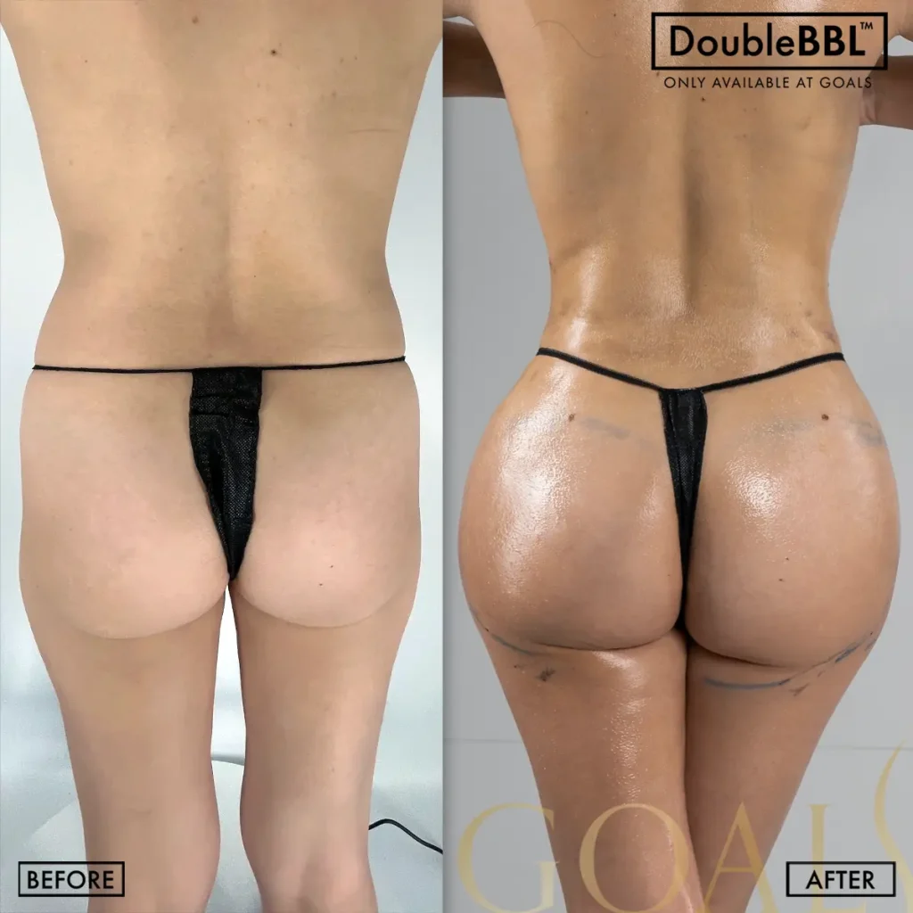 Before and after — Brazilian Butt Lift · Ridgefield, patient 4