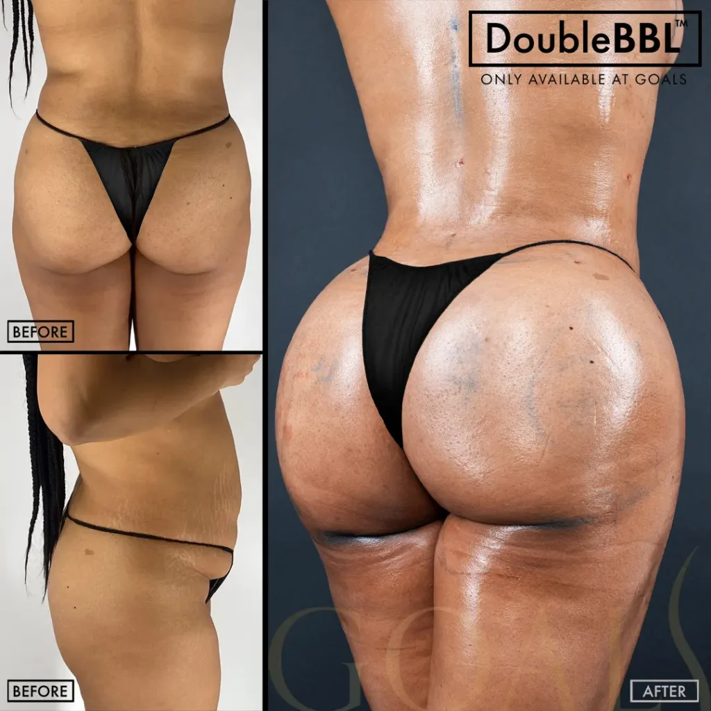 Before and after — Brazilian Butt Lift · Ridgefield, patient 5
