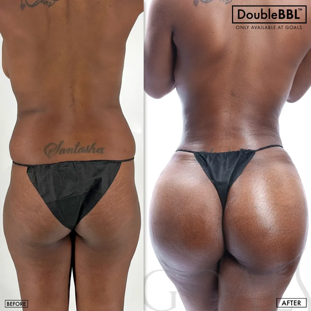 Before and after — Brazilian Butt Lift · Ridgefield, patient 6