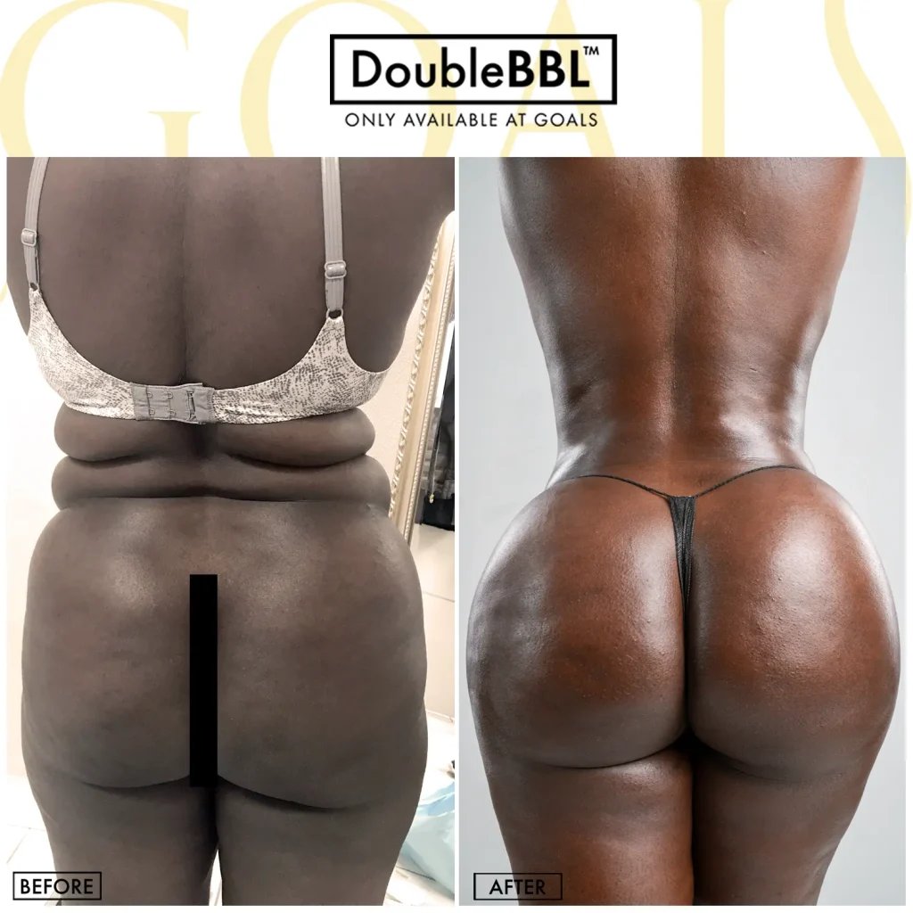 Before and after — Harlem, patient 4
