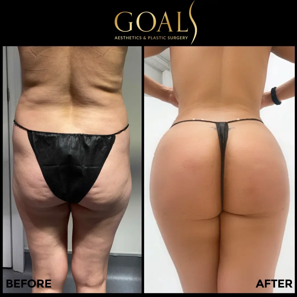 Before and after — Brazilian Butt Lift, patient 2