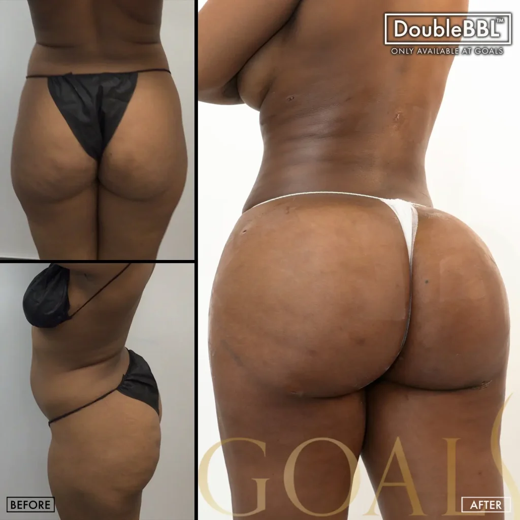 Before and after — Brazilian Butt Lift, patient 3