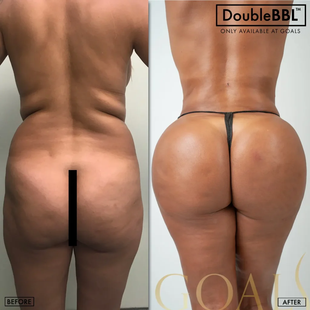 Before and after — Brazilian Butt Lift, patient 2