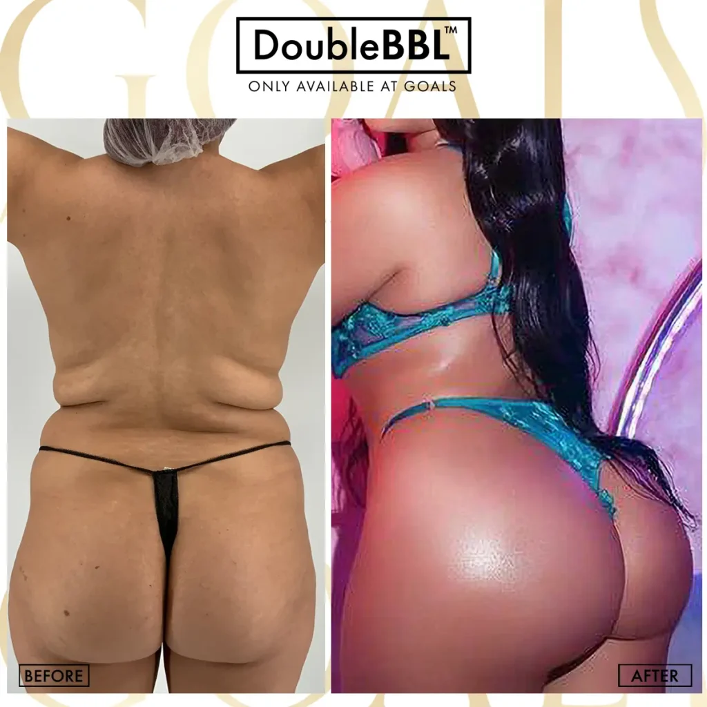 Before and after — Brooklyn, patient 2
