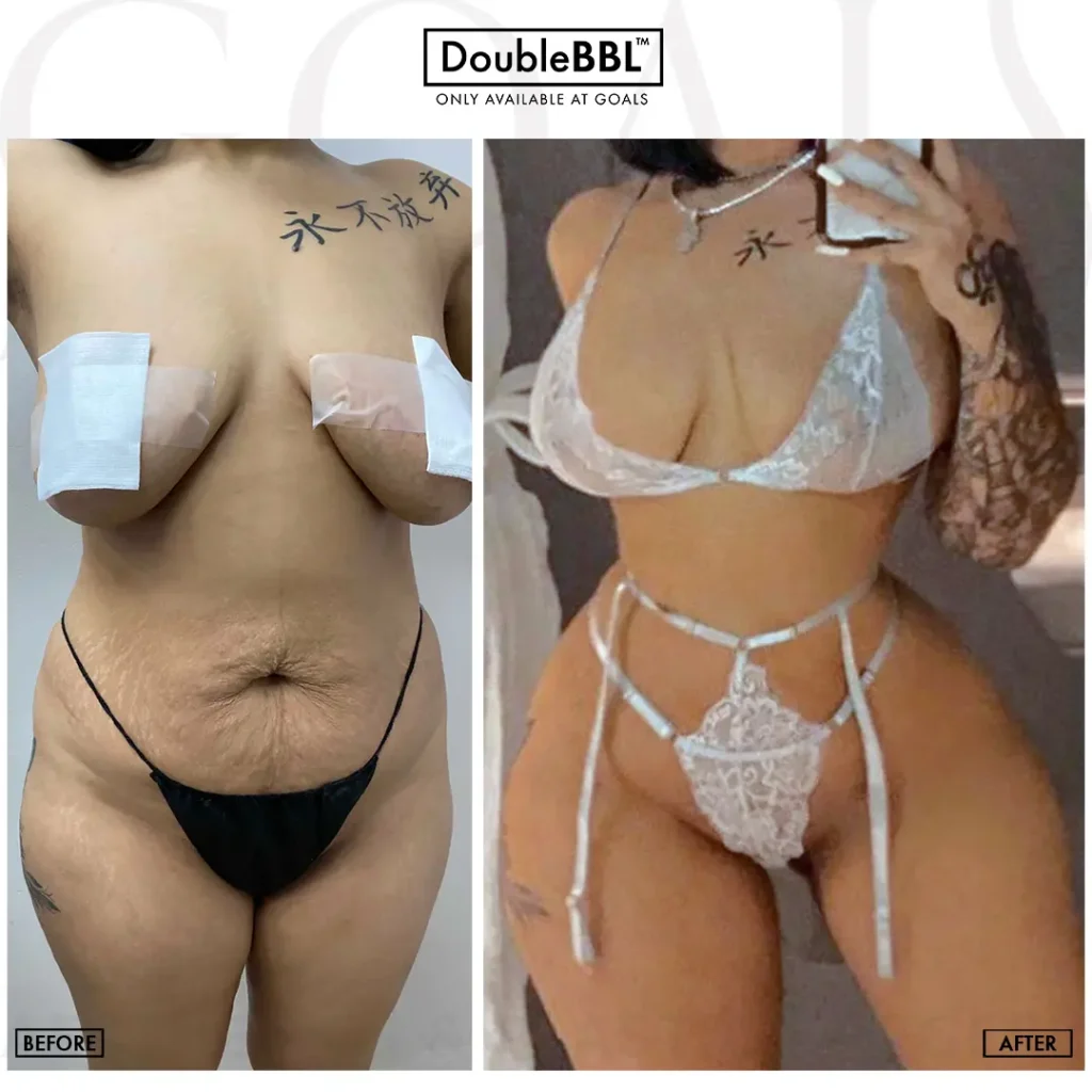 Before and after — Philadelphia, patient 2