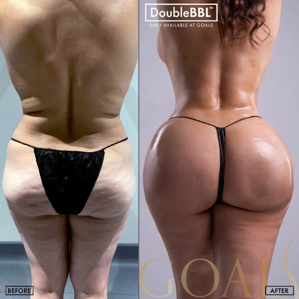 Before and after — Atlanta Tucker Rd., patient 1