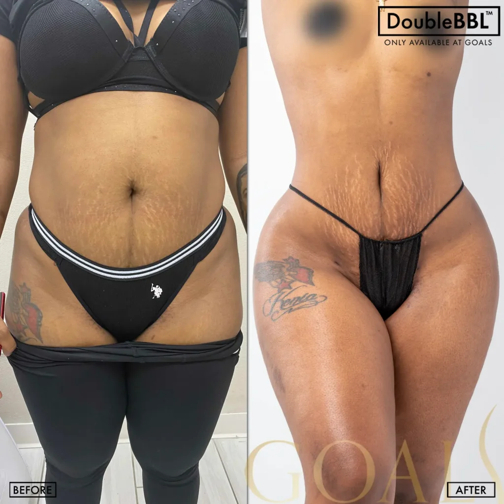 Before and after — Brazilian Butt Lift, patient 1