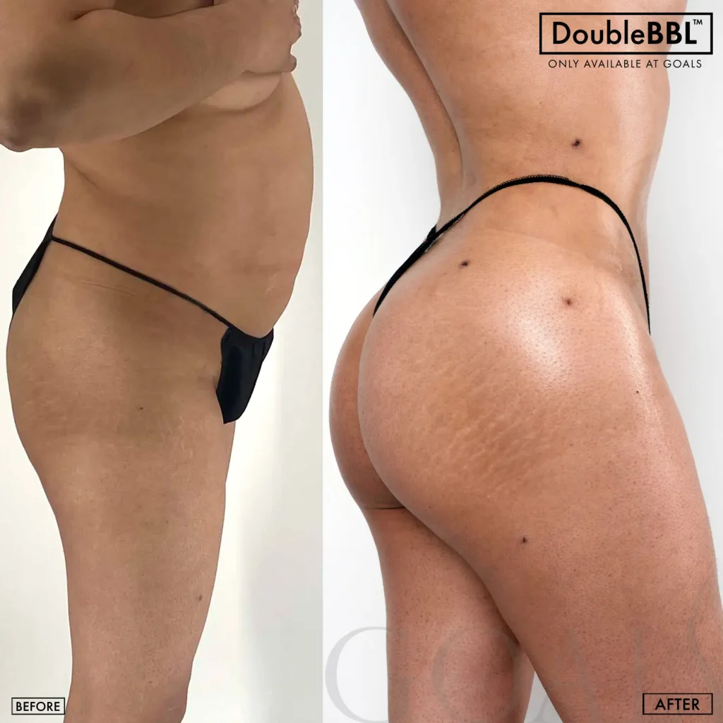 Before and after — Brazilian Butt Lift, patient 2