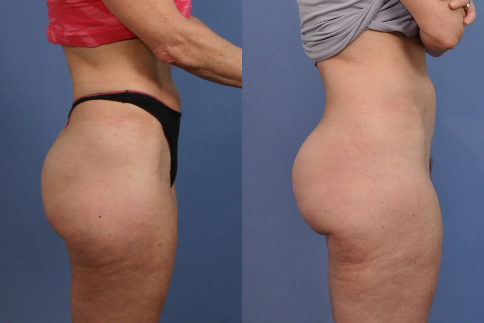 Before and after — Brazilian Butt Lift, patient 3