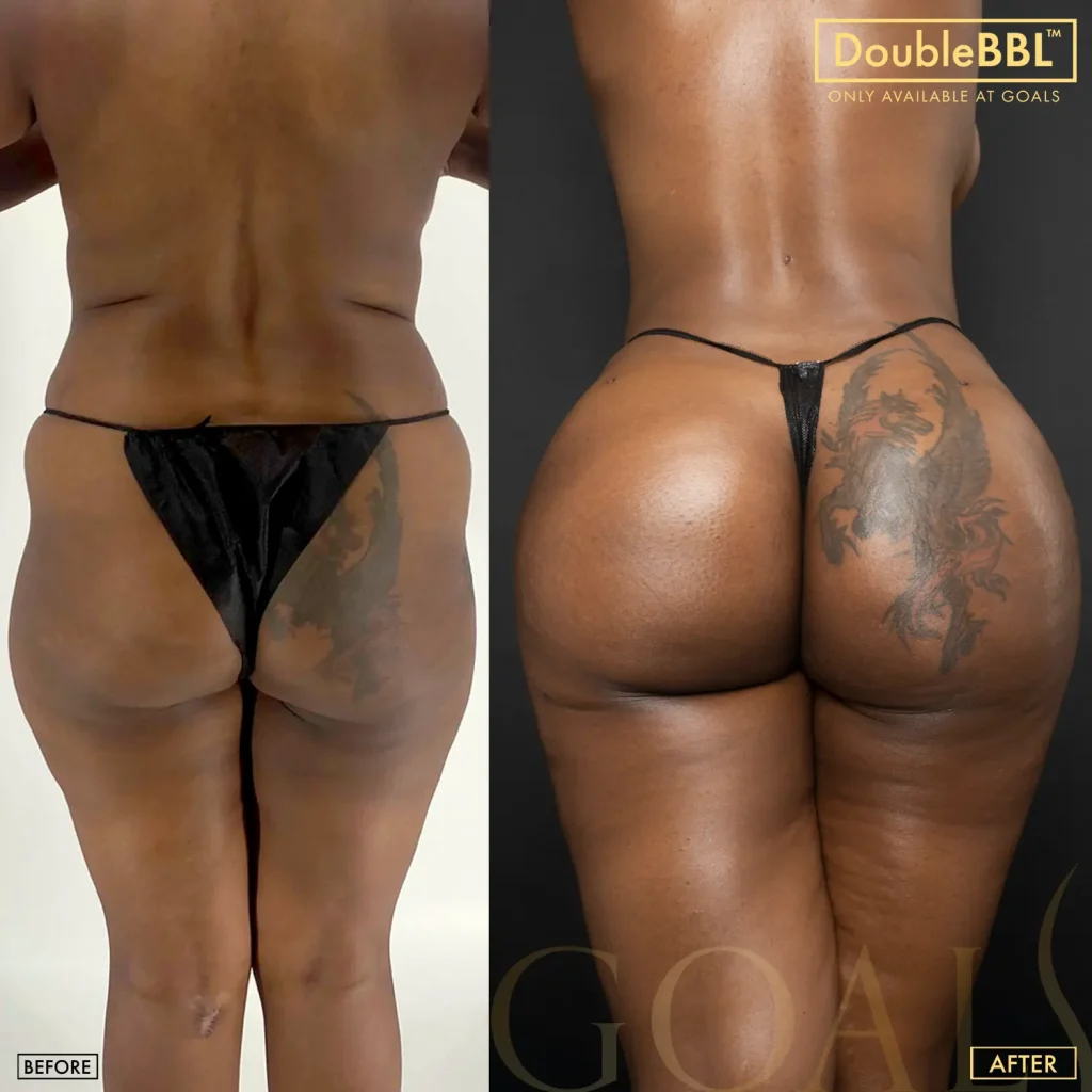Before and after — Brazilian Butt Lift, patient 6