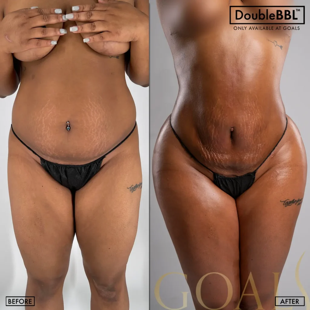 A Goals patient's brazilian butt lift result