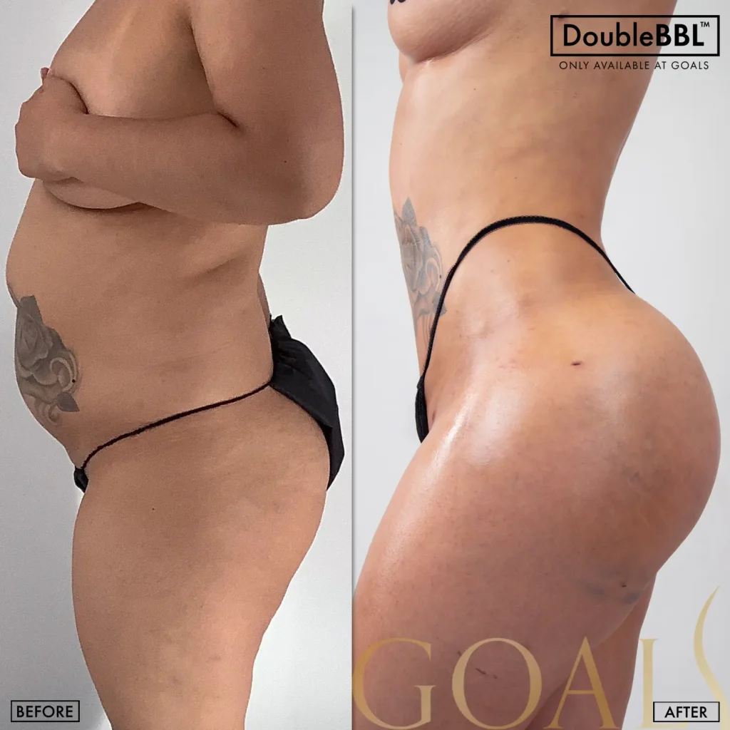 Before and after — Atlanta Tucker Rd., patient 2