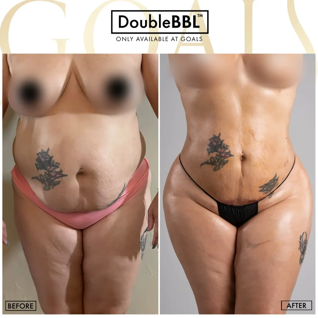 Before and after — Atlanta Tucker Rd., patient 3