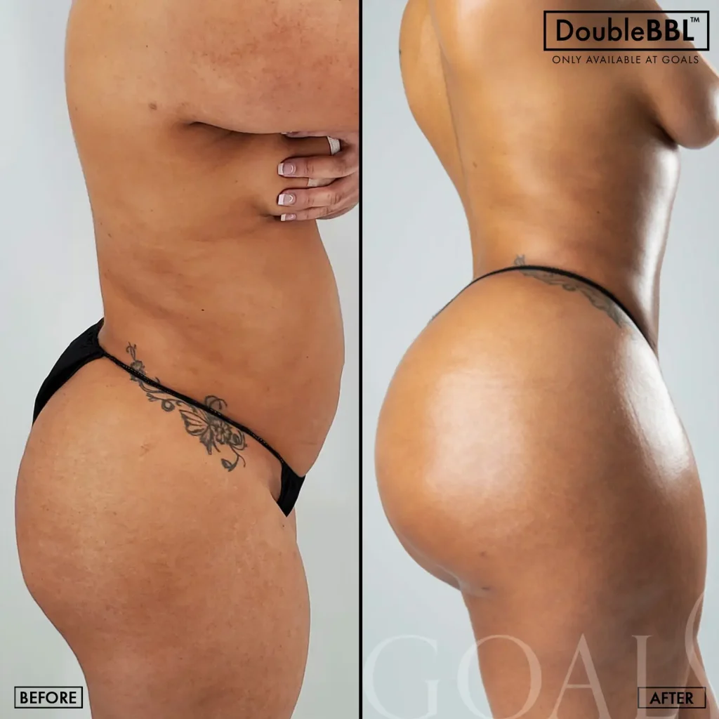 Before and after — Brazilian Butt Lift · Fair Lawn, patient 1
