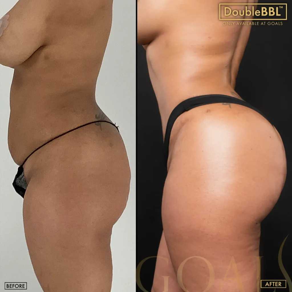 Before and after — Brazilian Butt Lift · Fair Lawn, patient 2