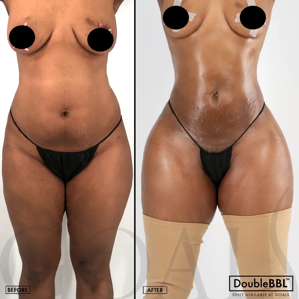 Before and after — Brazilian Butt Lift · Fair Lawn, patient 6