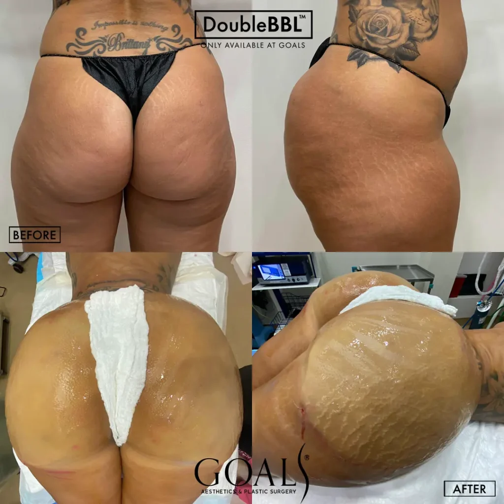 Before and after — Brazilian Butt Lift, patient 2