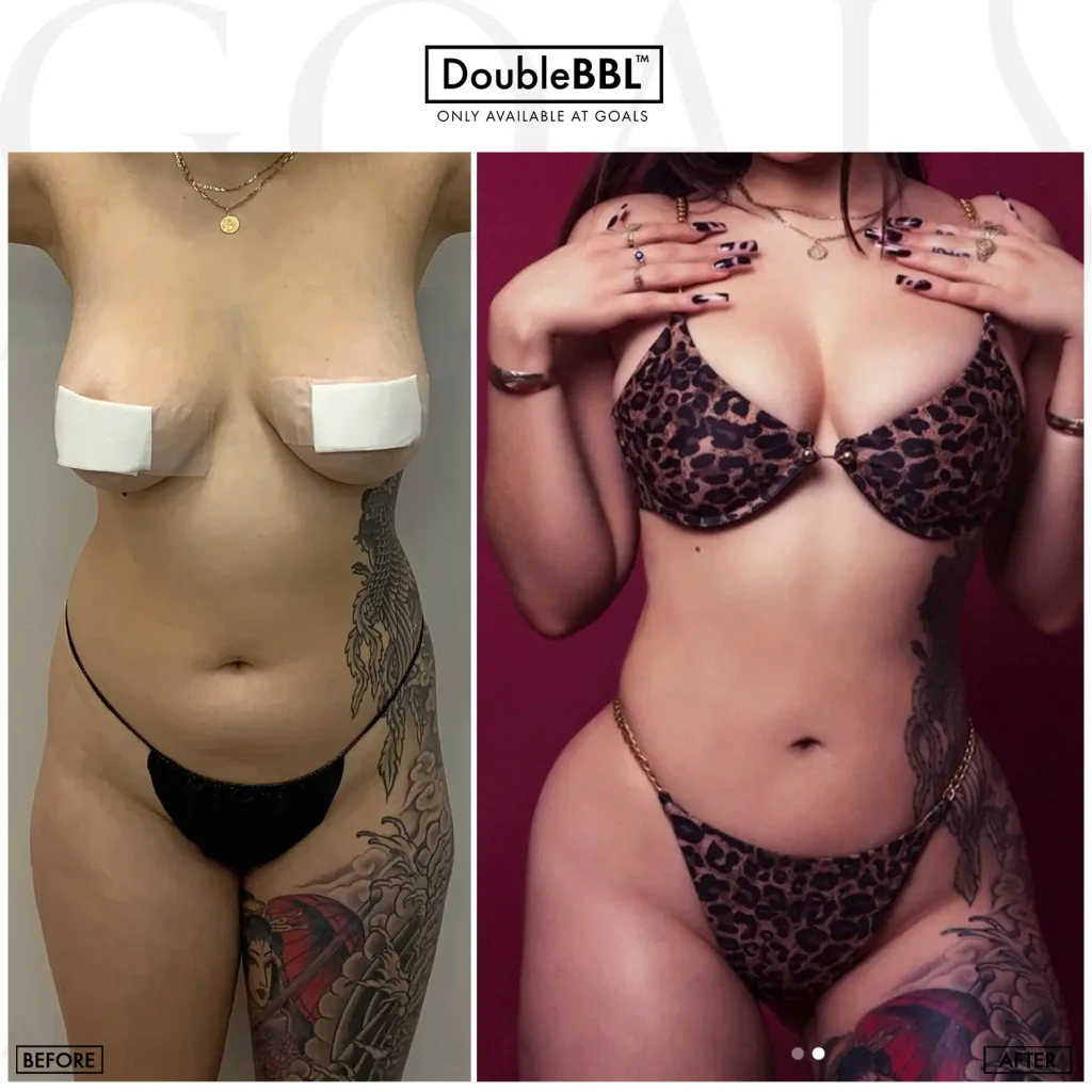 Before and after — Brazilian Butt Lift, patient 6