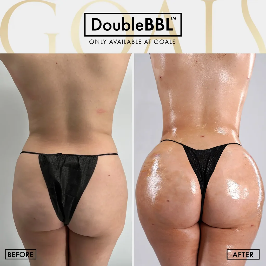 Before and after — Brazilian Butt Lift · Ridgefield, patient 6