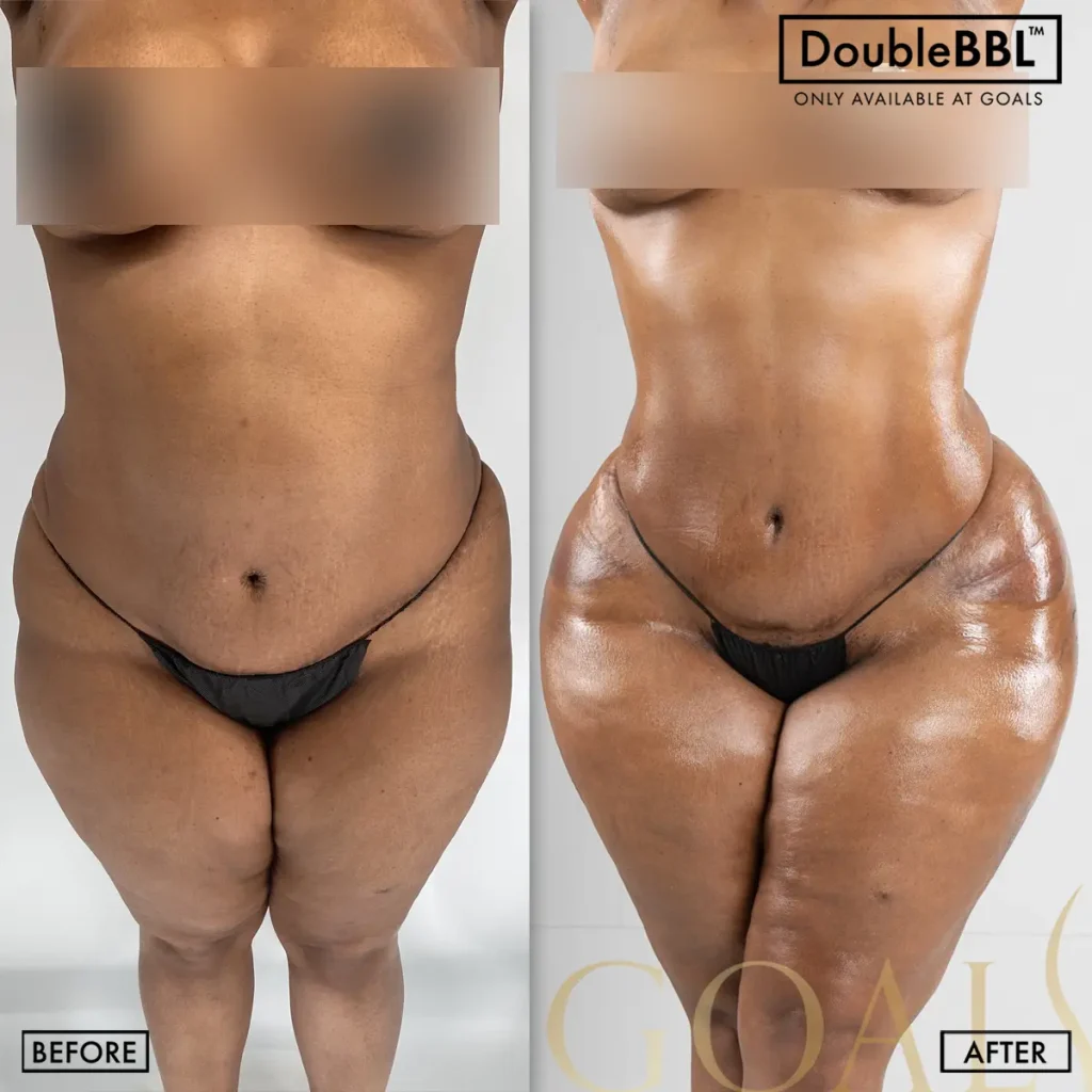 Before and after — Harlem, patient 1