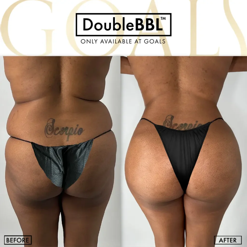 Before and after — Brazilian Butt Lift · Los Angeles, patient 1