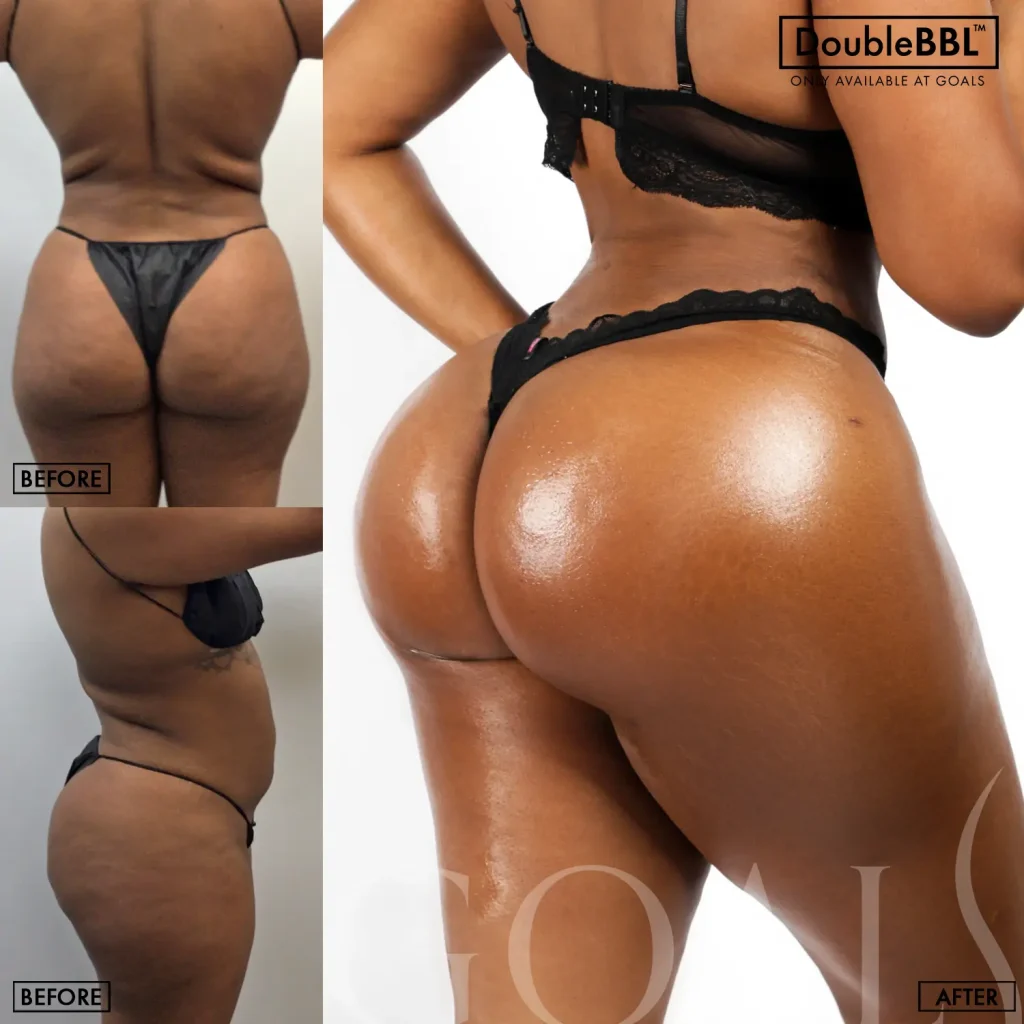 Before and after — Brazilian Butt Lift · Los Angeles, patient 3