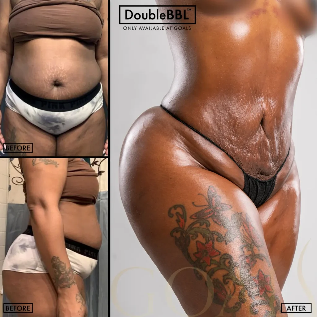 Before and after — Brazilian Butt Lift · Los Angeles, patient 5