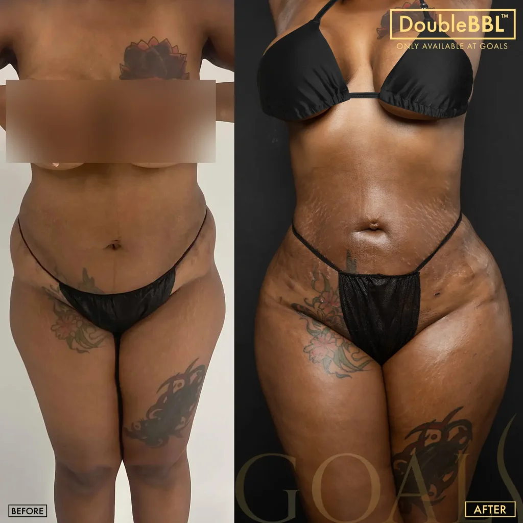 Before and after — Brazilian Butt Lift · Los Angeles, patient 6