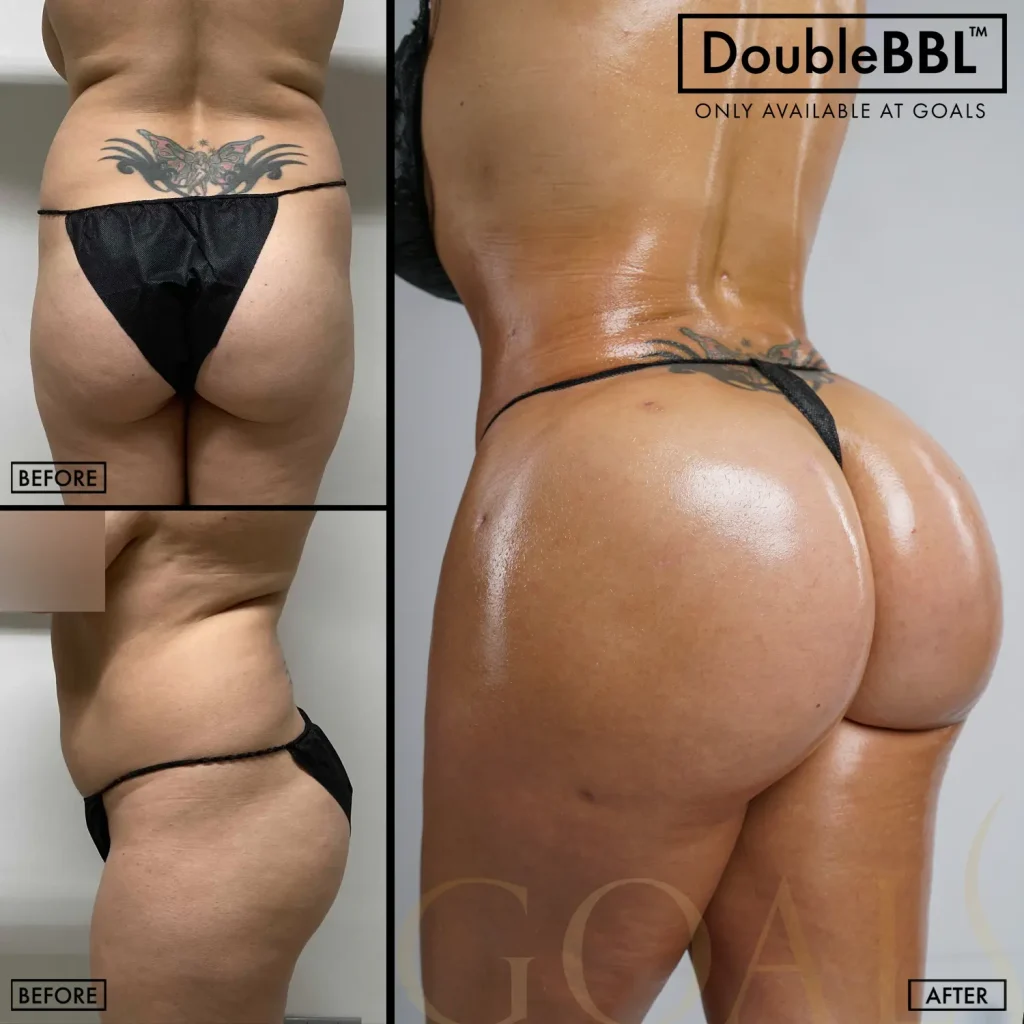 Before and after — Brazilian Butt Lift · Brooklyn, patient 3