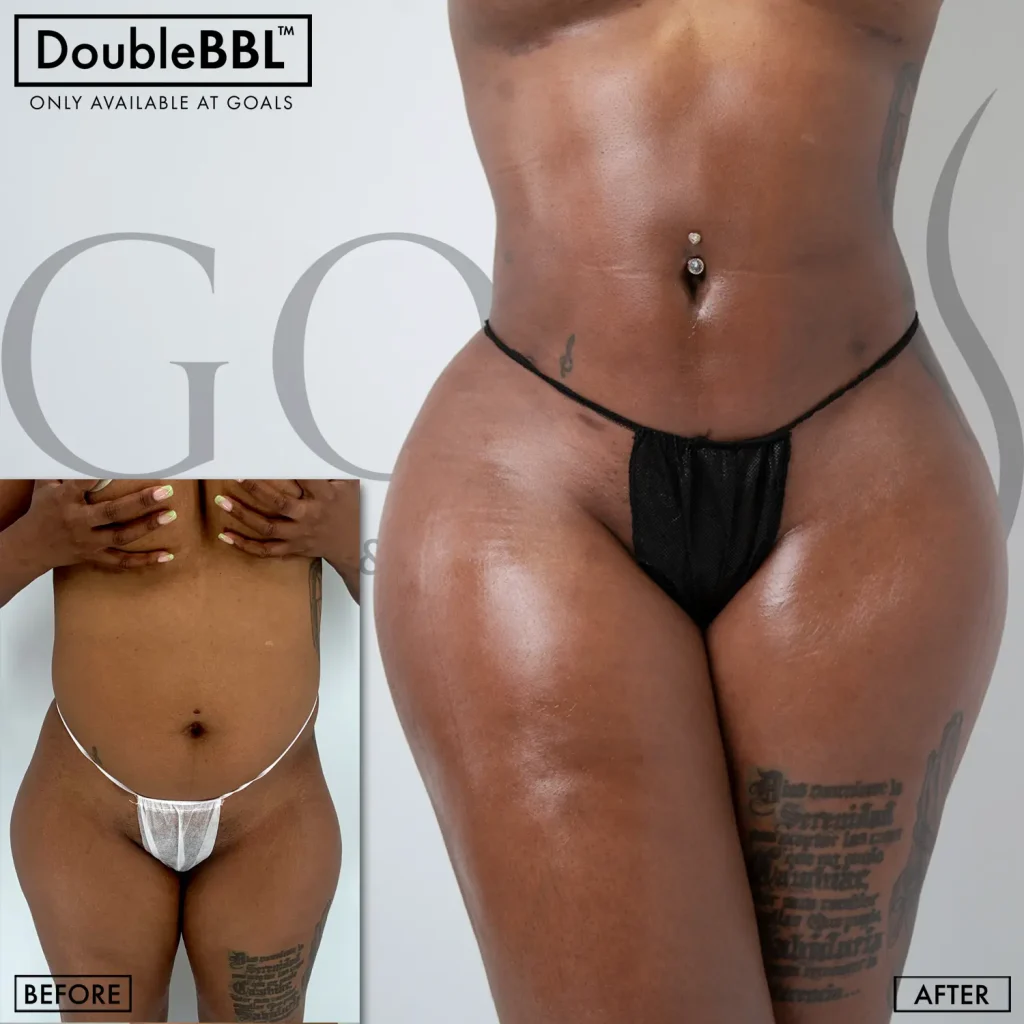 Before and after — Brazilian Butt Lift · Brooklyn, patient 4
