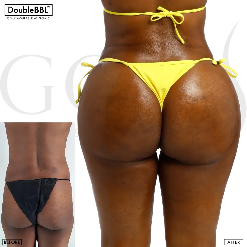 Before and after — Brazilian Butt Lift · Brooklyn, patient 6