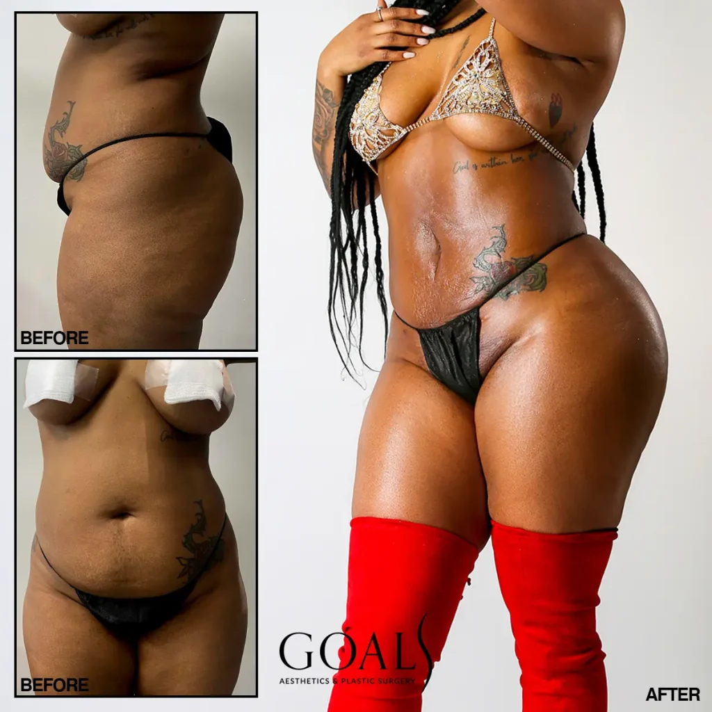 Before and after — Brazilian Butt Lift, patient 1