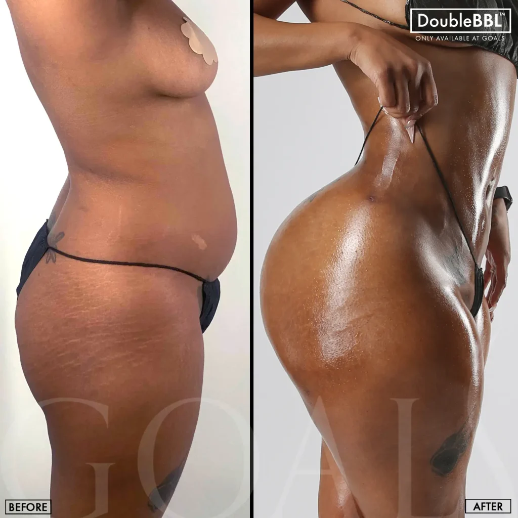 Before and after — Brazilian Butt Lift, patient 4