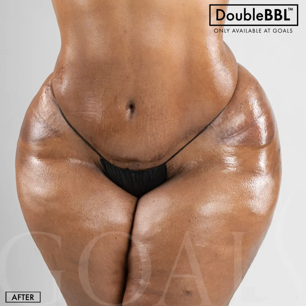 Before and after — Brazilian Butt Lift, patient 5