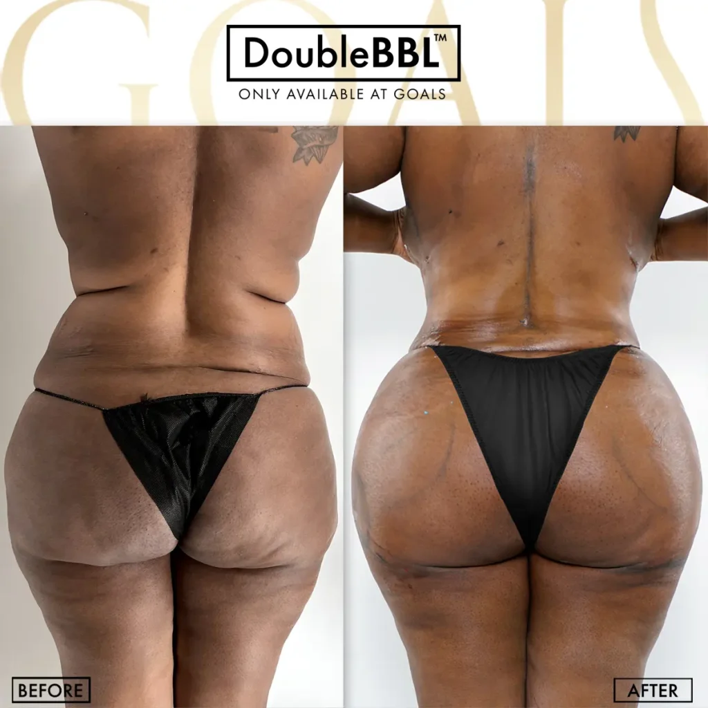 Before and after — Brazilian Butt Lift, patient 6