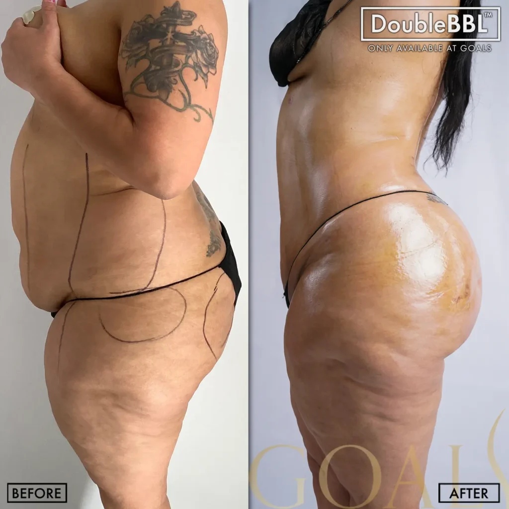 Before and after — Harlem, patient 5