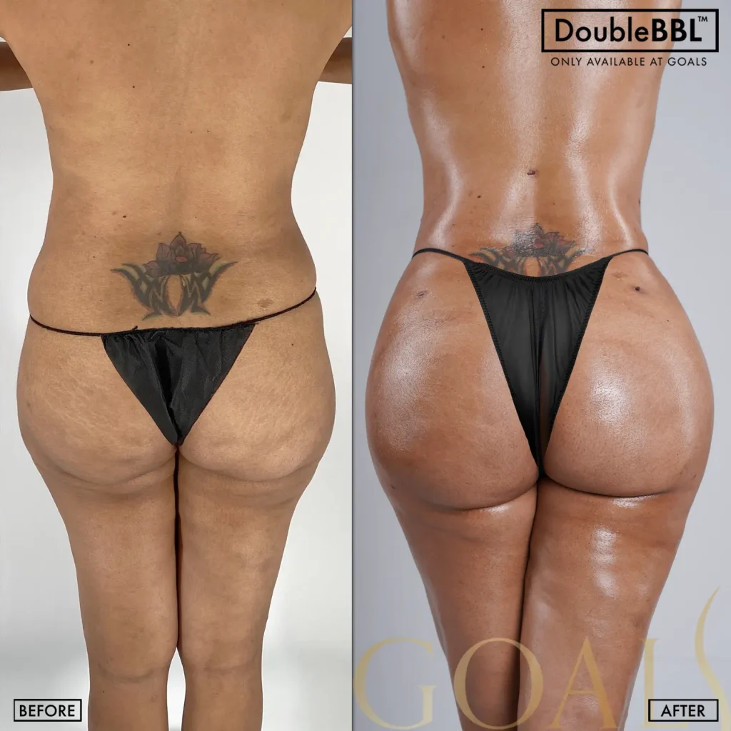 Before and after — Philadelphia, patient 1