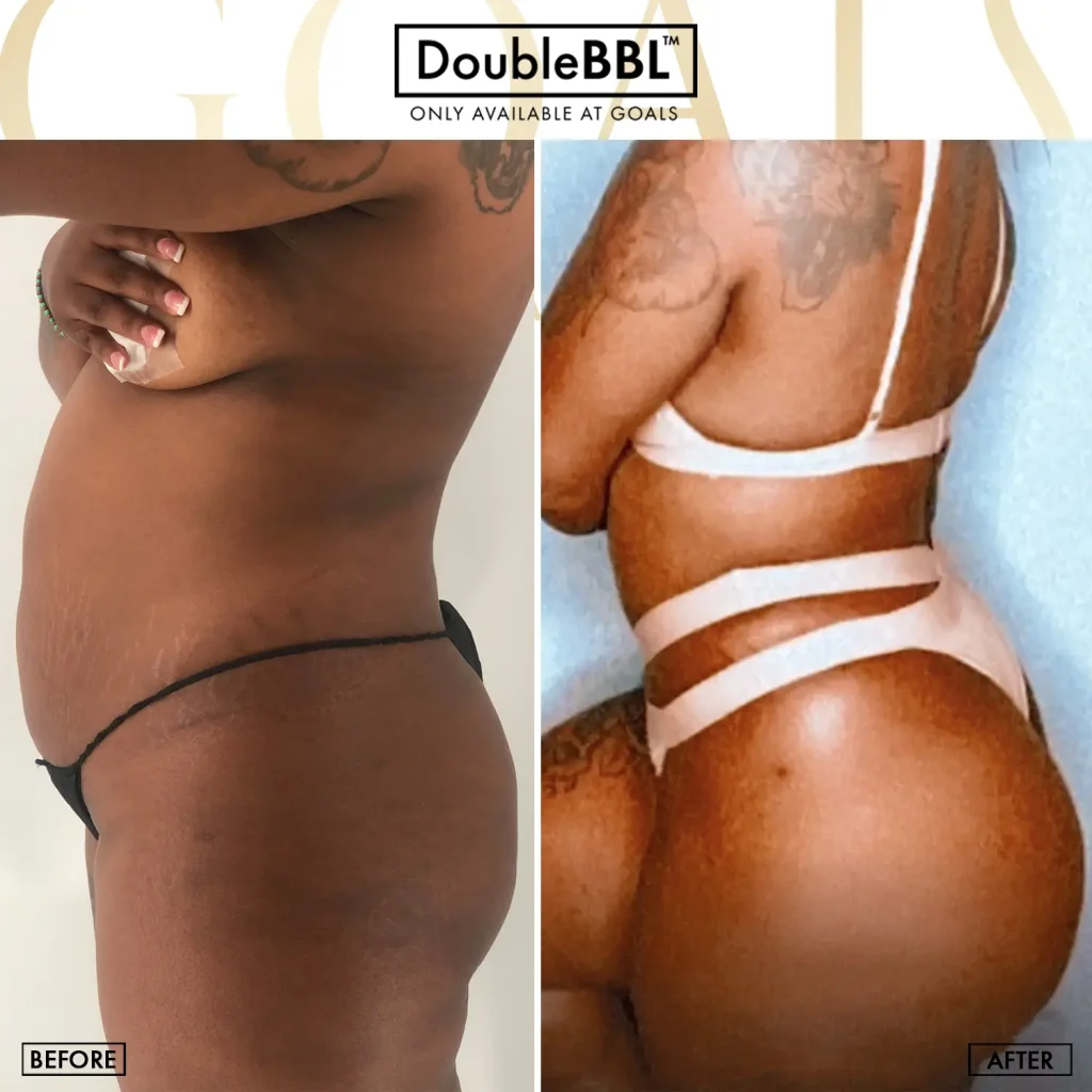 Before and after — Harlem, patient 1
