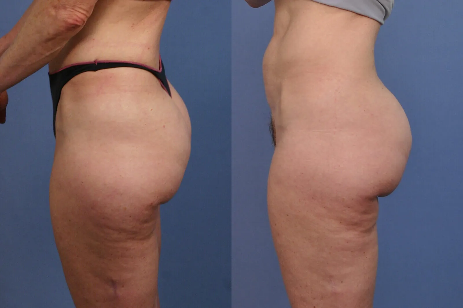 Before and after — Fair Lawn, patient 3