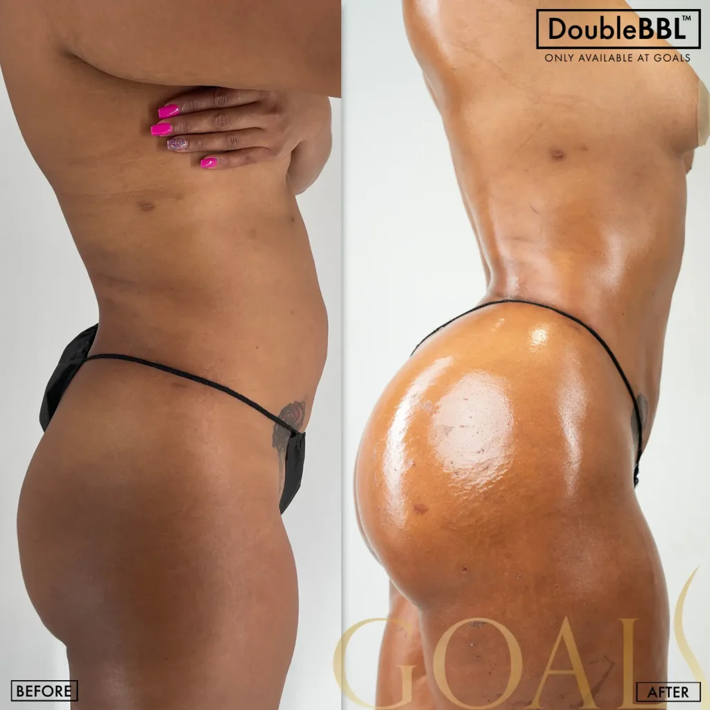 Before and after — Los Angeles, patient 1